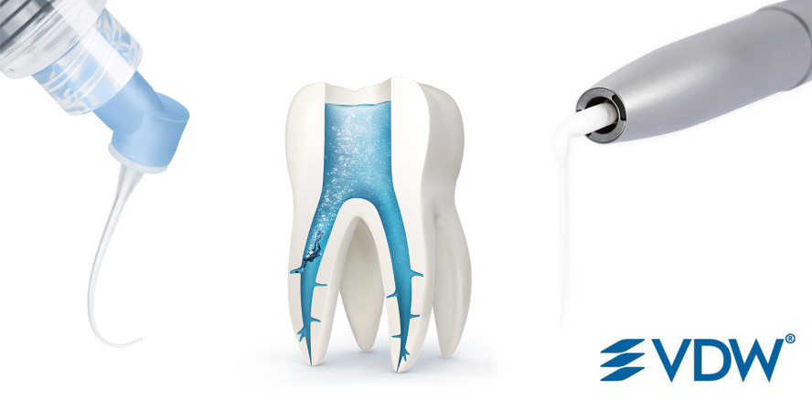 Endo mit EDDY: schallaktivierte Kanalspülung