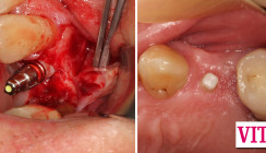 Das hülsenlos geführte keramische Implantat: Effizient, praktikabel, sicher