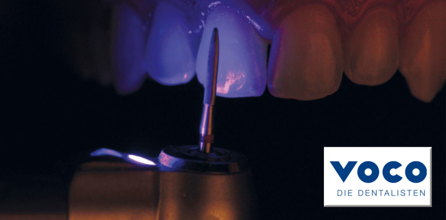 Fluoreszierende Komposite optimieren den Detachment-Prozess von Brackets