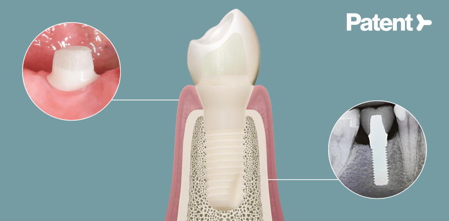Sollten wir Implantaterfolg nicht endlich langfristig denken?