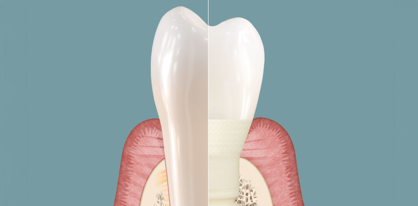 Symbionic Teeth: Der Zahnersatz mit der Schutzbarriere – ZWP online ...