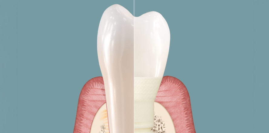 Symbionic Teeth: Der Zahnersatz mit der Schutzbarriere
