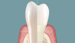 Symbionic Teeth: Der Zahnersatz mit der Schutzbarriere