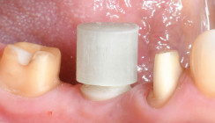 Innovative Implantatprothetik dank Glasfaseraufbau
