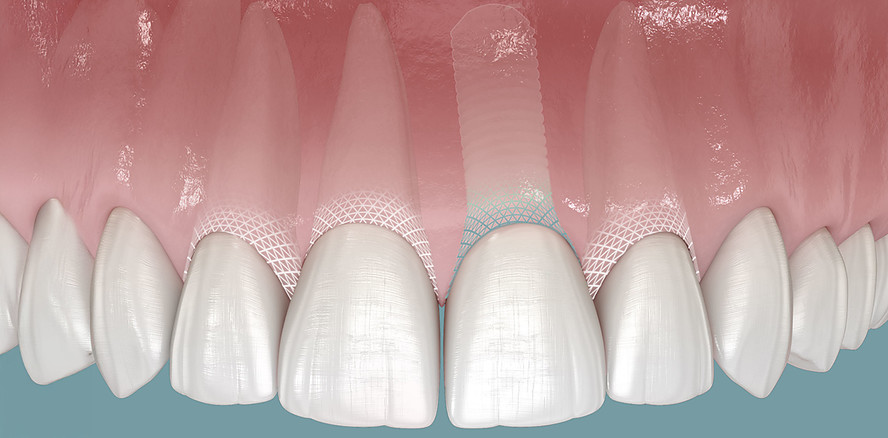 Periimplantitis vermeiden durch Schutzbarriere: Erfolg nachgewiesen