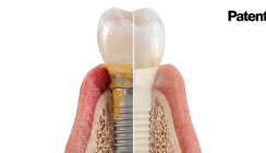 Symbionic Teeth: Mehr als herkömmliche Zahnimplantate