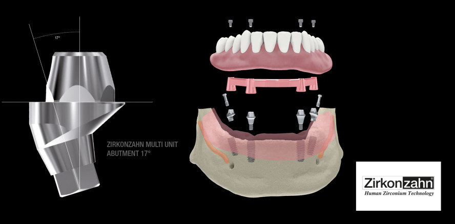 Neue Komponenten für die Implantatprothetik