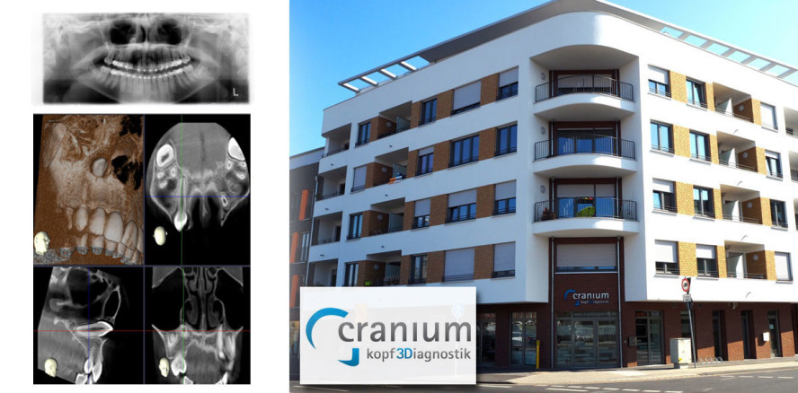 DVT-Diagnostik zur OP-Planung bei Zahntransplantation