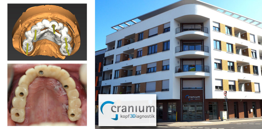 cranium-Patientenfall: Implantation im Oberkiefer mit Sofortversorgung