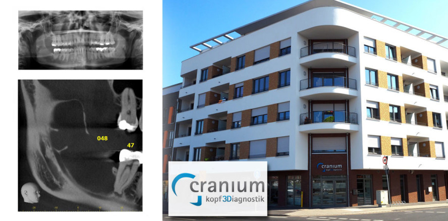 Zufallsbefund keratozystischer odontogener Tumor