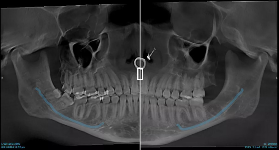 „Wie Tag und Nacht“ - Automatische Dosissteuerung für Röntgen