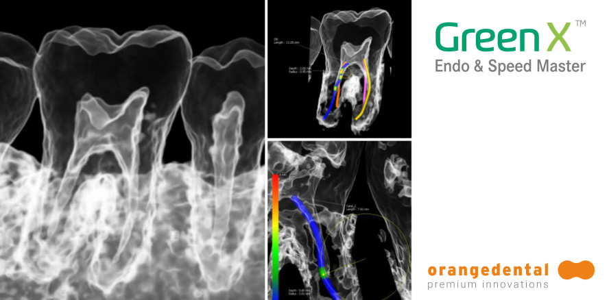 Green X – das DVT von orangedental mit 49μm Voxel Endo-Mode
