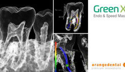 Green X – das DVT von orangedental mit 49μm Voxel Endo-Mode