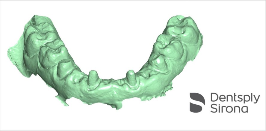 CEREC jetzt noch flexibler: Offener Scan-Export