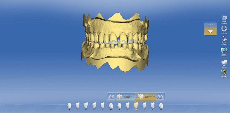 Minimalinvasive Rehabilitation mittels CAD/CAM bei Erosionsgebissen