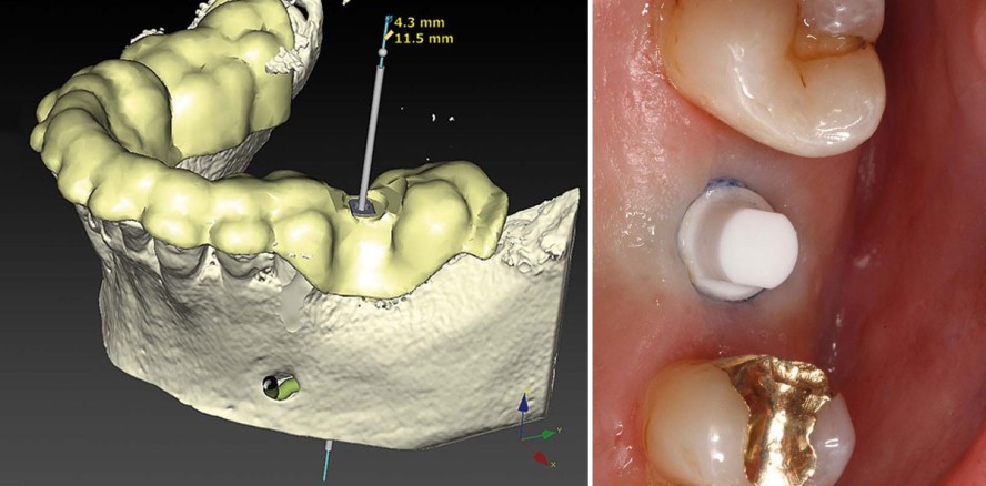 Ein einteiliges Keramikimplantat im digitalen Workflow