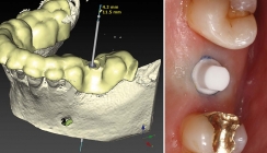 Ein einteiliges Keramikimplantat im digitalen Workflow