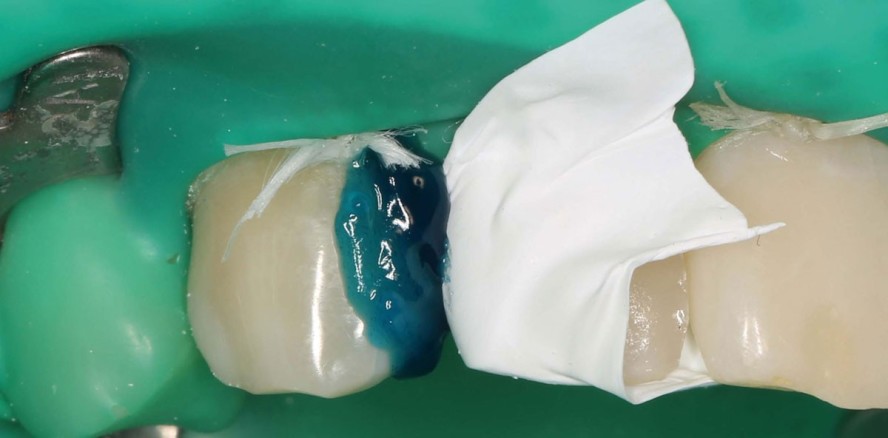 Einfaches Kompositsystem für komplexe Direktversorgungen