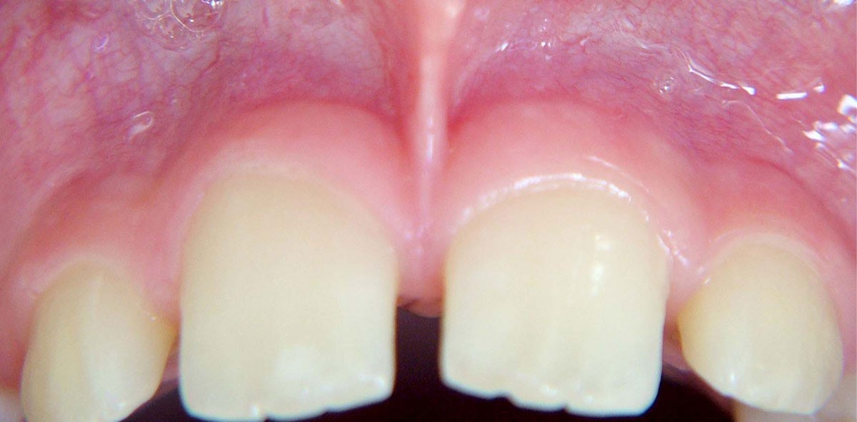 Lippenbandexzision unter Infiltrations- und intraligamentärer Anästhesie