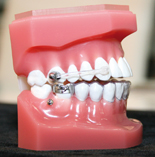 Carrière® Clear Distalizer (Fa. ODS).