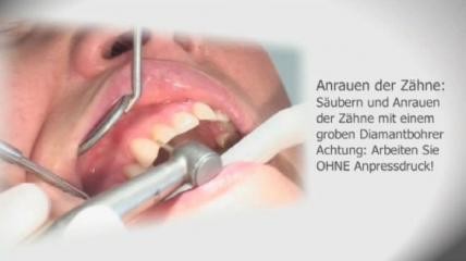 BriteVeneers Anwendervideo