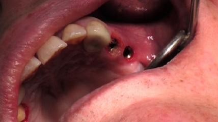 Implantatfreilegung: Vergleich CO2- und Erbium:YAG-Laser