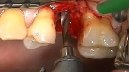 Mein erstes Implantat