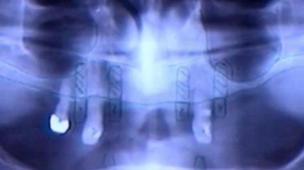 Unterkiefer-Sofortversorgung mit Kobolt Abutments auf Implantaten