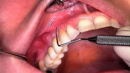 Biofilmmanagement bei Implantatpatienten