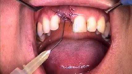 Knochenblocktransplantation und Implantation mit Sofortversorgung