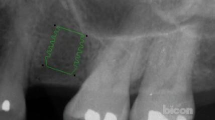 The Bicon SHORT Implant Surgical Technique