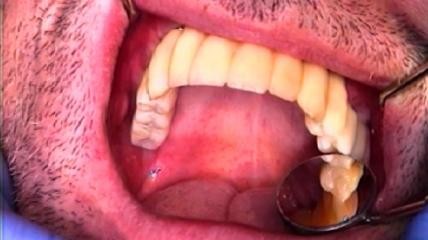 Langzeitprovisorium auf 8 Implantaten