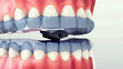 Scheu-Dental TAP®-Schiene