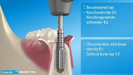 REVOIS® - Das komfortable Implantatsystem