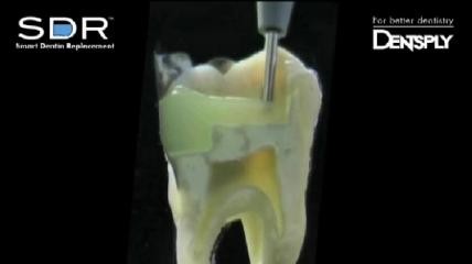 SDR Smart Dentin Replacement