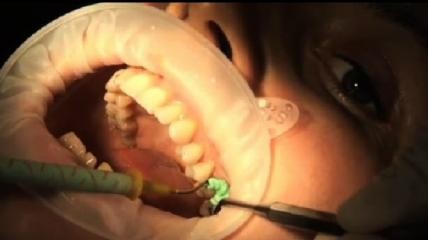 Centrix GingiTrac Video
