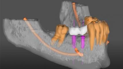 Materialise - SimPlant Go