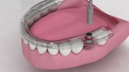 Heliocos Dentalimplantat-System