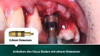 Interner Sinus Lift in Kombination mit SynthoGraft