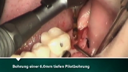 Einsetzen und restaurative Versorgung des Bicon SHORT® Implantates