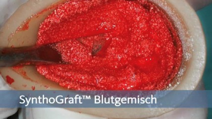 Bicons phasenreines Beta-Tricalciumphosphat