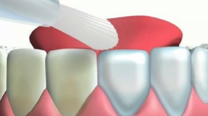 Mirawhite oxygen – Effektive Zahnaufhellung bei sensiblen Zähnen