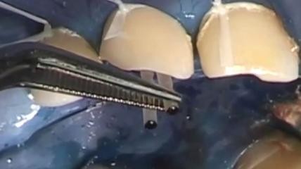 Sulzer Mixpac AG: MIXPAC Colibri - clinical application