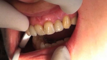 Implantation mit dem Genesis Implantat System durch Dr. Chu und Dr. Tarnow