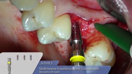 OT-F3 Implantat-Insertion mit Sinuslift-Osteotomie