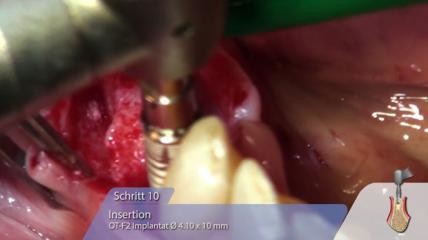 OT-F2 Implantat-Insertion