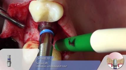 OT-F3 Implantat-Insertion mit Sinuslift