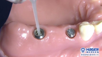 GapSeal: Zur Prävention von Periimplantitis