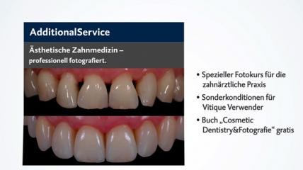 Vitique: Veneerbefestigung mit Mehrwert