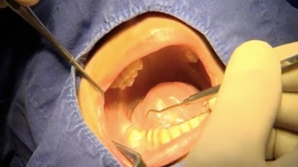 Vom Implantat bis zur Krone mit Dr. Christian Blum: Insertion in Regio 46
